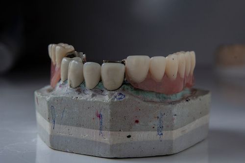 Korony metalowo-ceramiczne